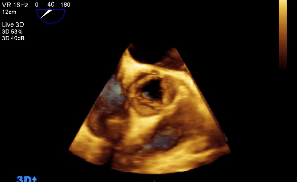 3D Echocardiography